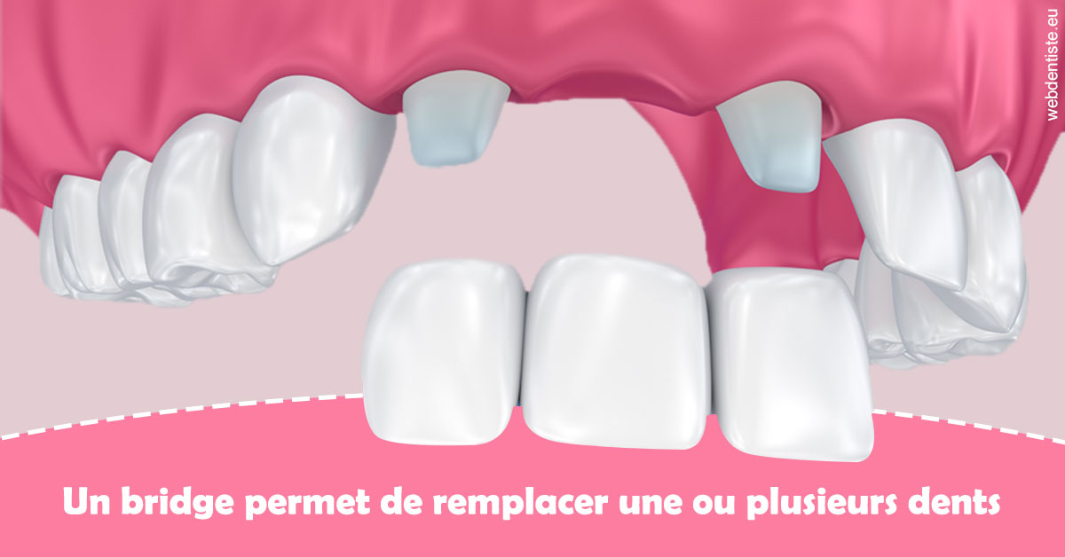 https://dr-carroy-frederic.chirurgiens-dentistes.fr/Bridge remplacer dents 2