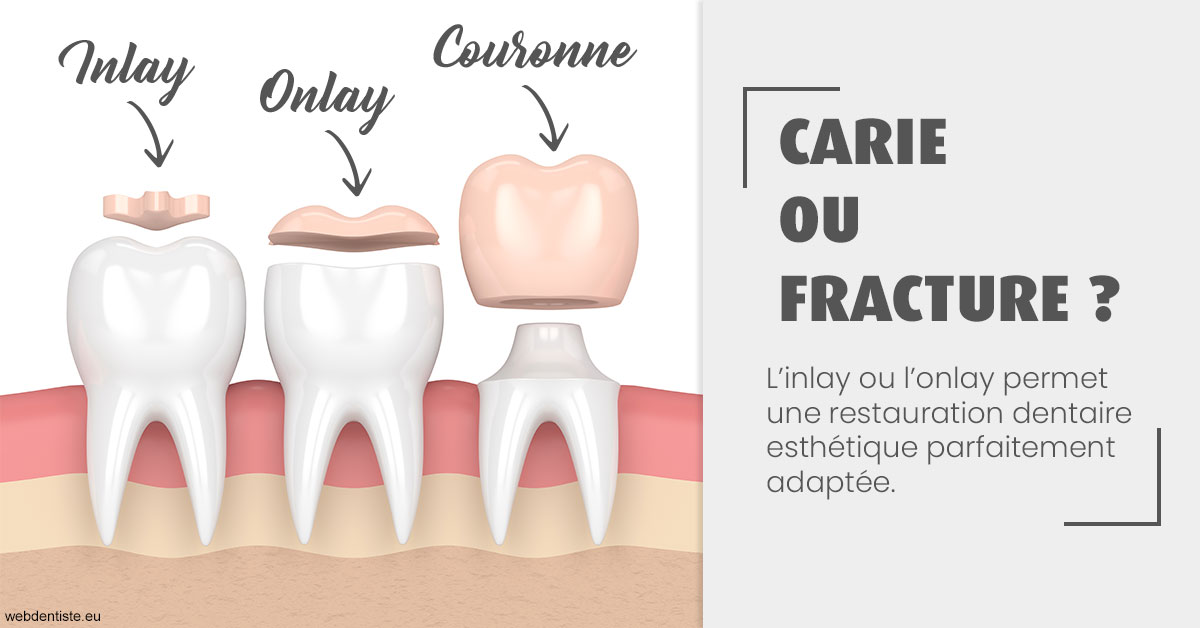 https://dr-carroy-frederic.chirurgiens-dentistes.fr/T2 2023 - Carie ou fracture 1