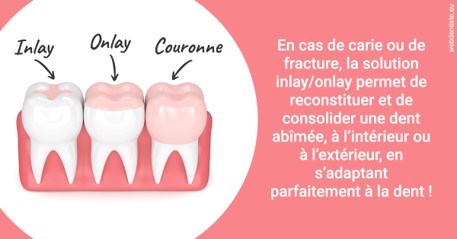 https://dr-carroy-frederic.chirurgiens-dentistes.fr/L'INLAY ou l'ONLAY 2