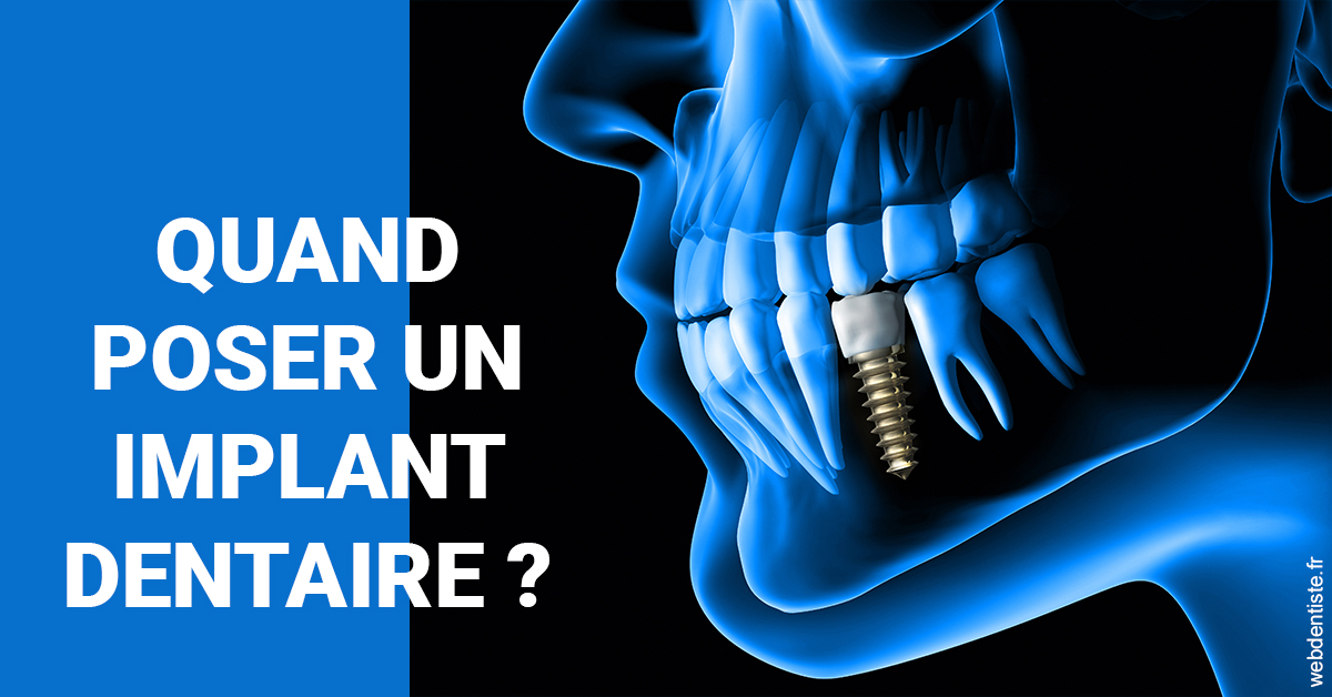 https://dr-carroy-frederic.chirurgiens-dentistes.fr/Les implants 1