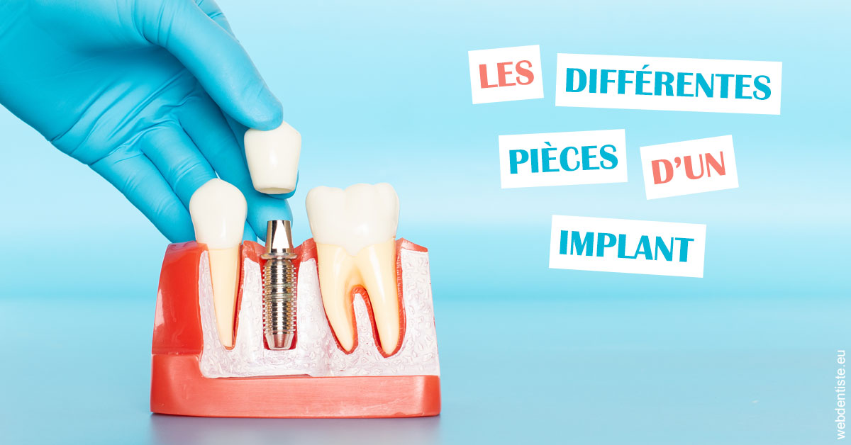 https://dr-carroy-frederic.chirurgiens-dentistes.fr/Les différentes pièces d’un implant 2
